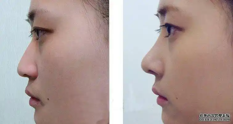 塌鼻子隆鼻前后对比