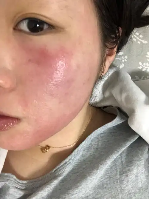 熟悉白白的宝宝应该都知道,白白之前的脸真的是极度的敏感,因为是过敏