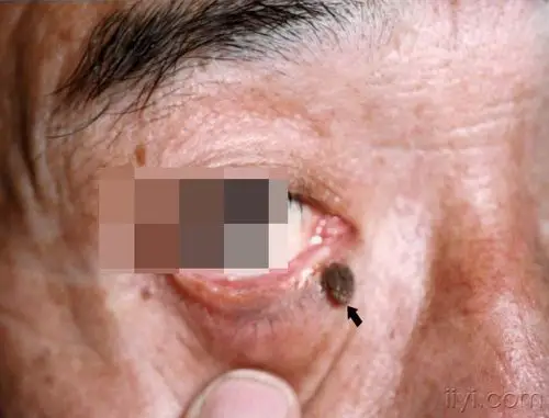 典型皮肤病照片集锦