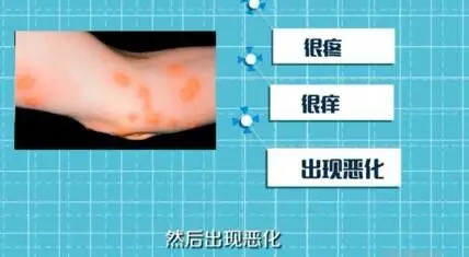 跳蚤咬的症状有哪些,被跳蚤咬了用什么药最有效