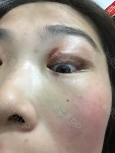 通过新氧消费方案查看埋线双眼皮微创轻度疼痛双眼皮