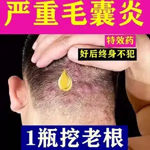 治头皮毛囊炎专用头部脖子前胸后背私处马拉色菌痘痘中药酊的膏药