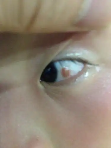 我宝宝从出生到现在眼晴里不知道长的是什么,随着眼