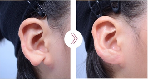 宝宝6种常见畸形耳朵图片照分析各种方案应对不同