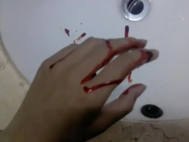 医保重症感染定义 伤口感染医保