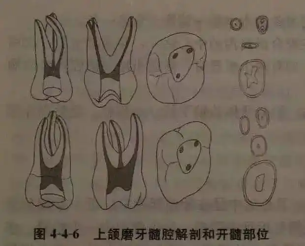 单根管牙的髓室和根管为连续的管状,很难从形态上辨认根管口;多根牙则