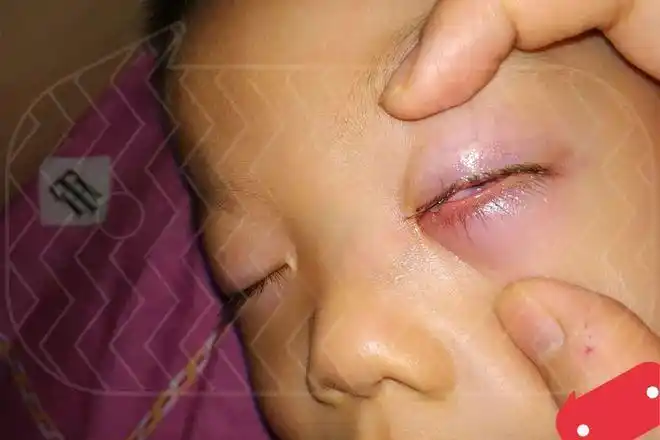 过敏|炎症|红霉素|下眼睑_网易订阅