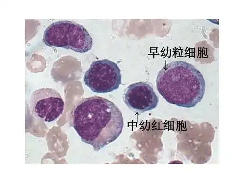 实验诊断学 早幼粒细胞 ↓ ↑ 中幼红细胞