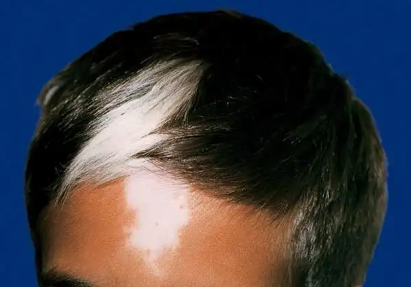 孩子出生就发现前额一小撮白头发,这是白癜风吗?