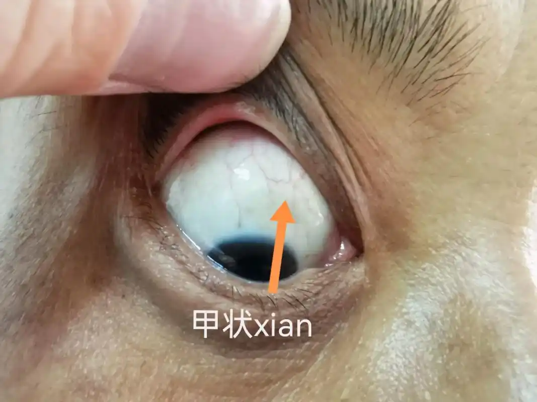目诊 观眼知健康,如果自己眼睛有这样的血丝就要注意了 - 抖音