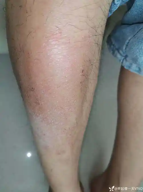 反复双下肢皮肤瘙痒不适2 年