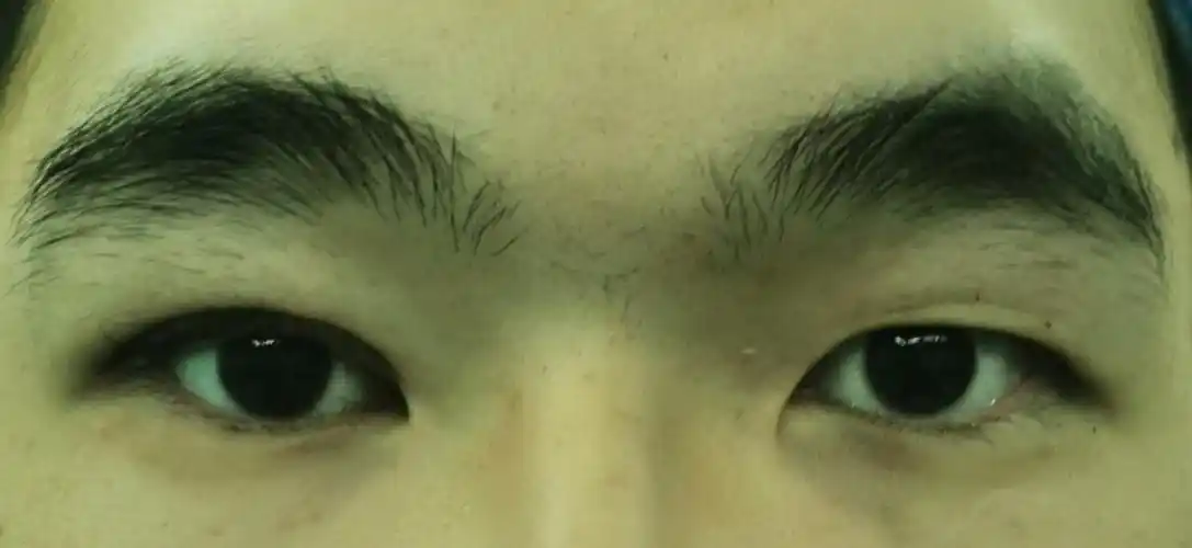 各种上睑下垂术前术后对比照 - 好大夫在线