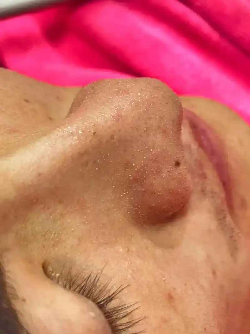 毛囊清洁 #深层毛孔清洁 好皮肤一定少不 - 抖音