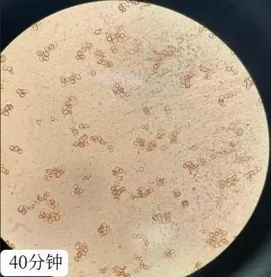 因意外抗体假凝集导致的交叉配血不合却意外发现镜下桃源