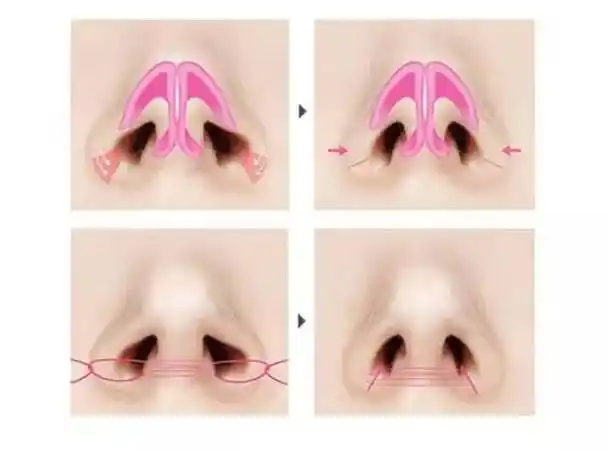 我来告诉你鼻翼缩小怎么做