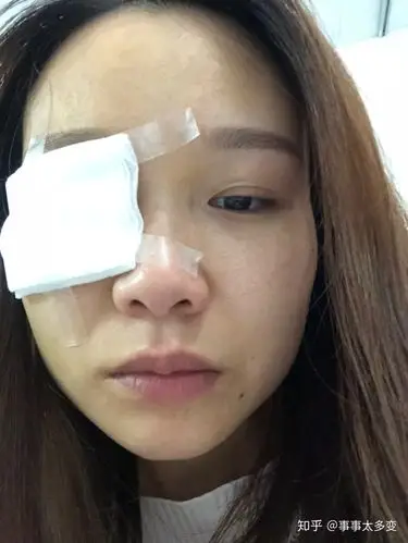 眼结膜色素痣治疗记录