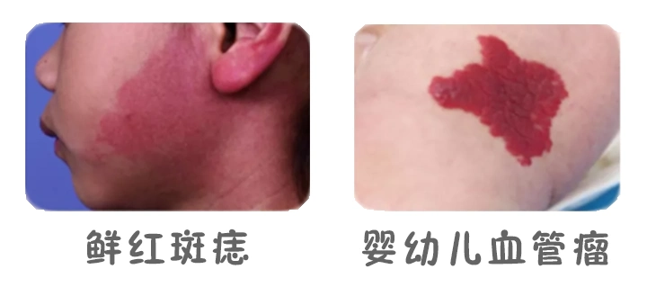 如何区分鲜红斑痣和血管瘤?