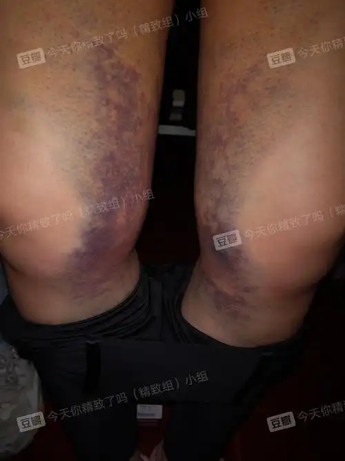 这还只是大腿膝盖内侧的,大腿背侧外侧和臀部都有.真的很痛.