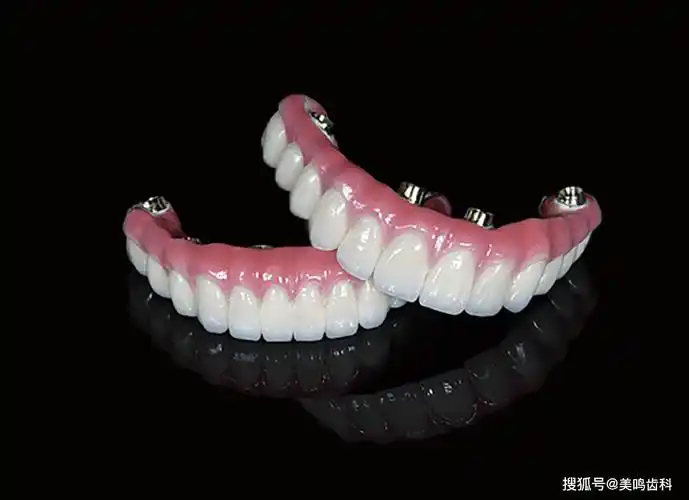缺牙新生——美鸣数字化精准种植桥解决方案_患者_全口_功能