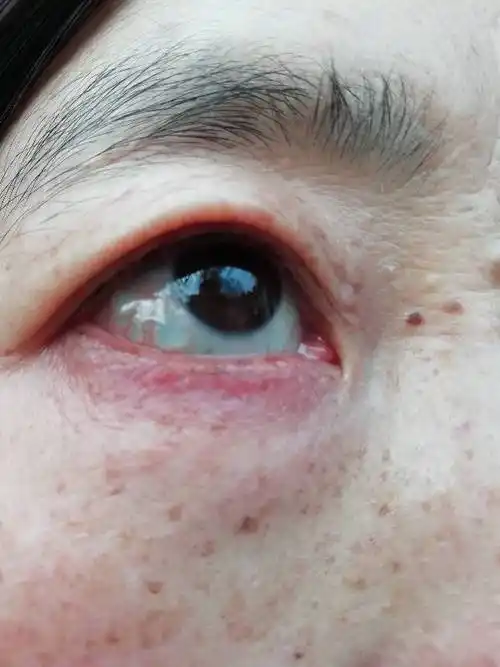 wl我妈眼睛上长个水泡状的东西,是什么,该用什么眼膏