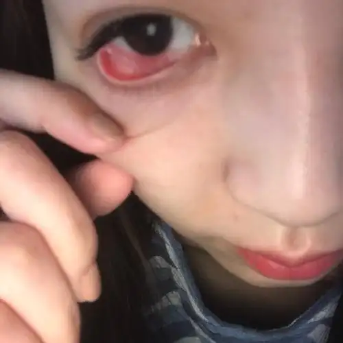 嫁接睫毛 导致眼睛感染结膜炎十分严重,慎入!