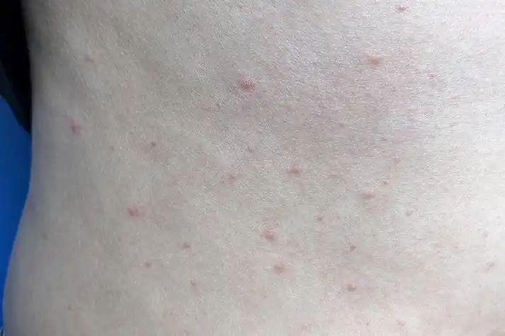 艾滋病初期躯干部位小红点图