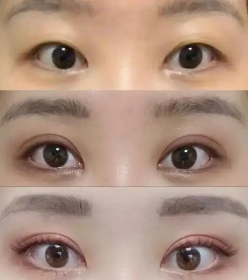 虽然割双眼皮的技术越来越成熟,但也不适合所有人去做的.