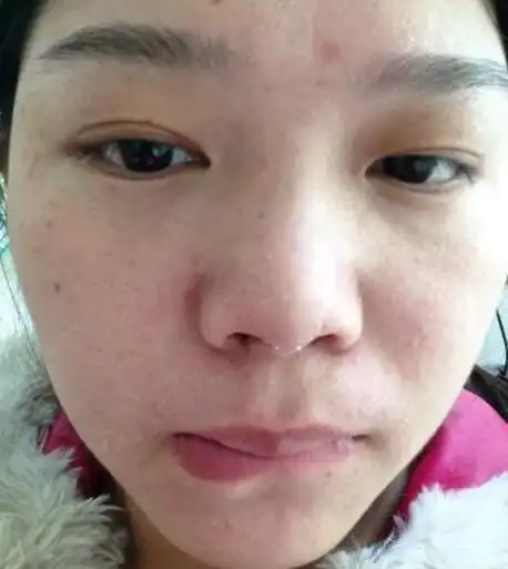 水杨酸的洗面奶,先把脸部清洁一下清洁的过程中一定要重点清洗脸上