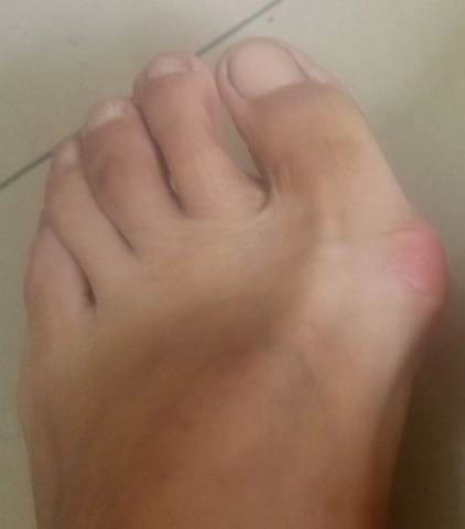 人为什么会得大脚骨?