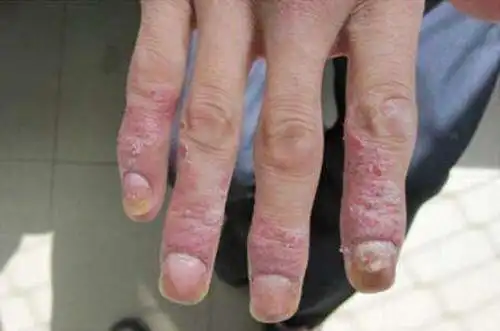 寻常型银屑病图片及症状图片
