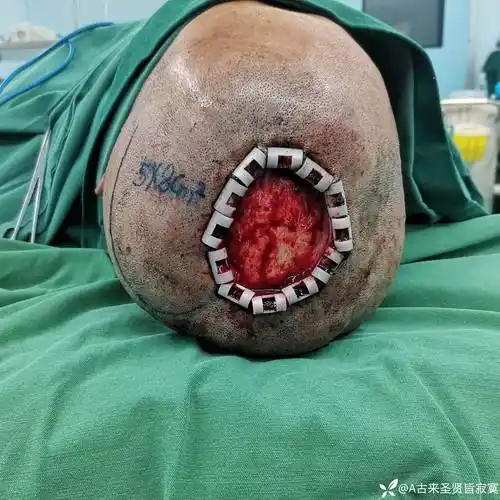 手术已经做了 - 丁香园论坛