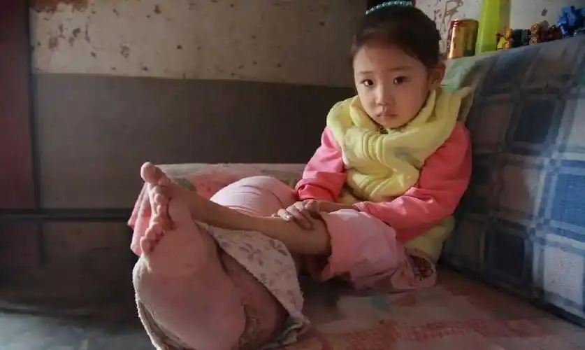 5岁漂亮女童腿粗如大象脚,无钱治疗靠吃止痛片维持生命