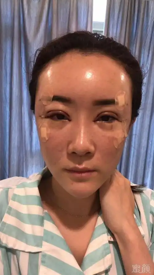 「自体脂肪填充 眼综合—日记分享」如果你变好看了.