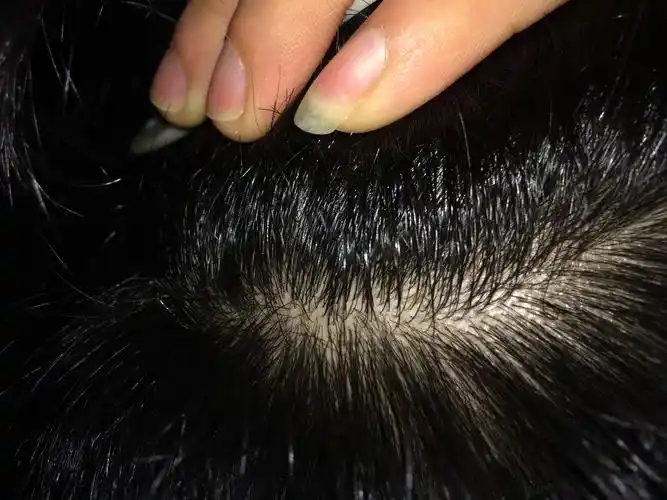 是热症要怎么治疗? 麻烦各位专家请指点一下我该怎么办.