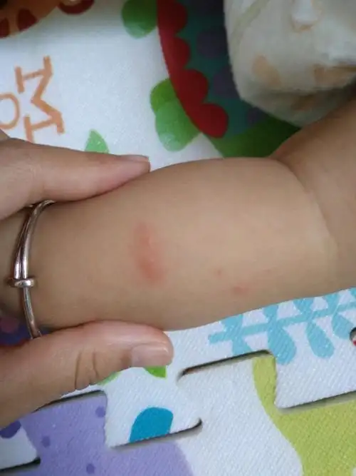 请问这是鸡蛋过敏么?