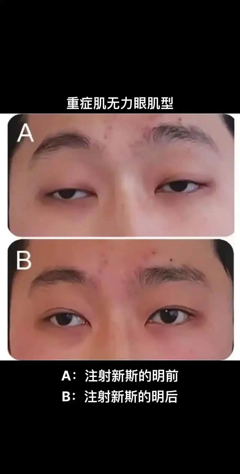 重症肌无力眼肌型一般指眼肌型重症肌无力,主要表现为眼睑下垂的症状