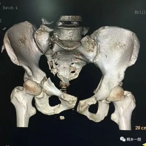 桐乡一院成功实施复杂骨盆骨折微创内固定手术