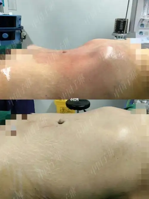 威塑腰腹环吸案例分享