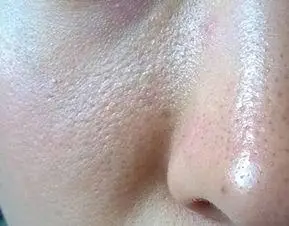 怎样判断脸上有角质?