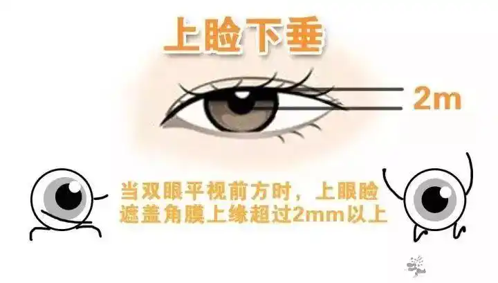 警惕上睑下垂你可能也有不要忽视