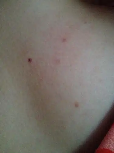 胸前有好多小红点点怎么回事?