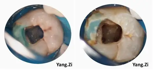 下颌第二磨牙c3型弯曲根管一例
