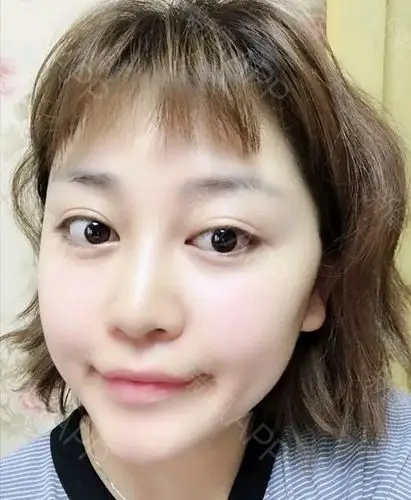 玻尿酸填充卧蚕