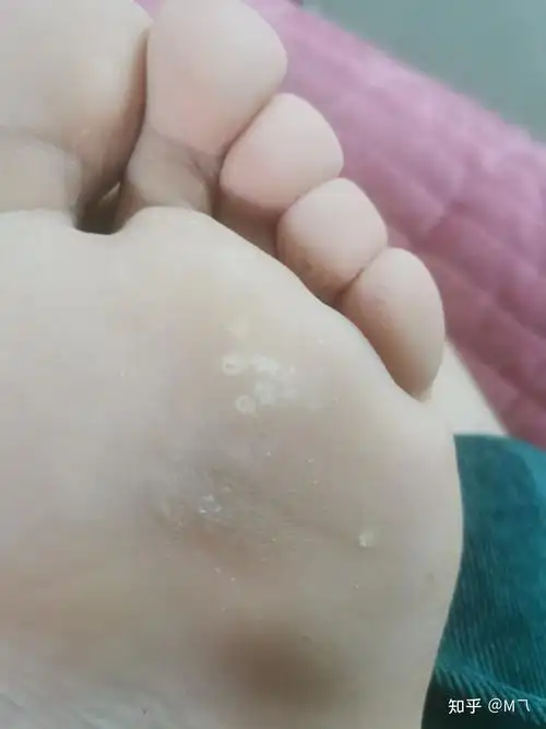 泡完脚发现脚底板上有很多白泡,不痛不痒,谁知道这是什么? - 知乎