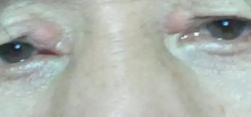 两只眼睛的内侧眼角,一夜之间同时各长出一个肿包,有没有内行的人说出