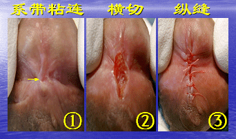 包皮环切术后包皮过短的处理