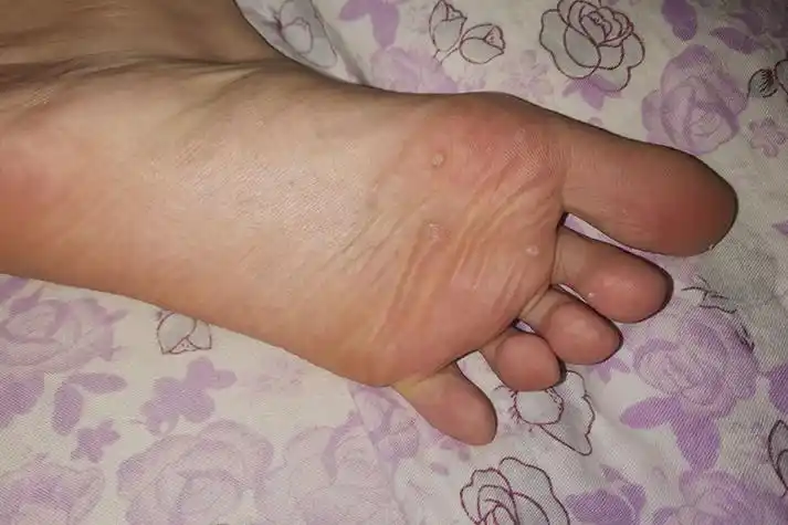 hpv疣体早期图片_有来医生