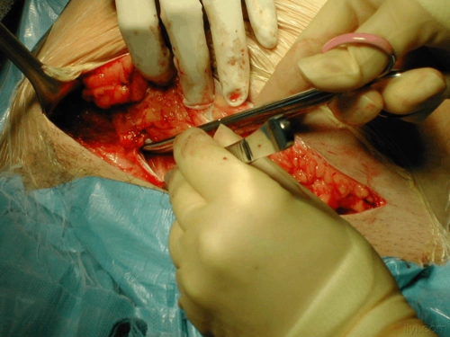 一组高清晰的剖腹产手术照片