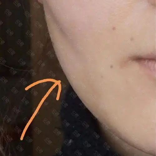 疫情期间拔牙不能及时矫正,结果老了快10岁