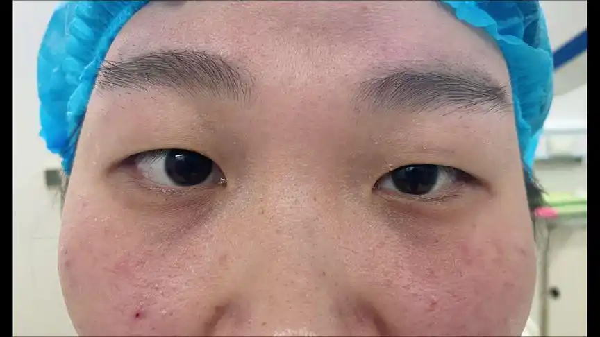 上睑下垂 #双眼皮 术前左右眼明显不对称,一侧上睑肌力不足
